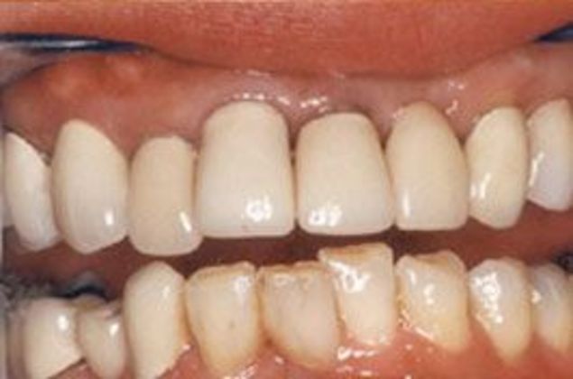 Close-up of upper and lower teeth with wear, misalignment, and discoloration