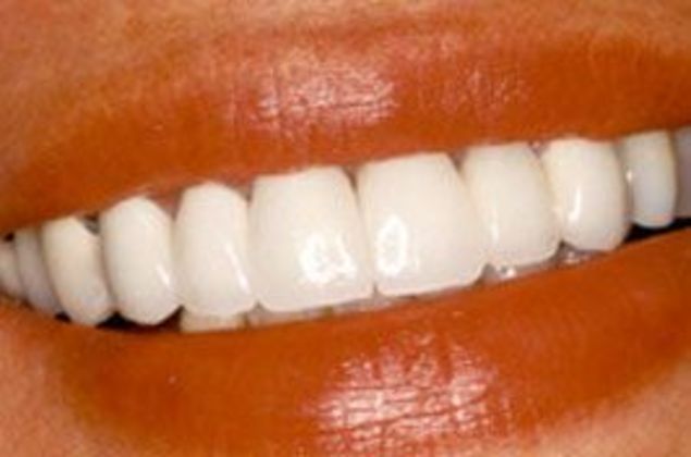 Smiling mouth showing bright, evenly shaped upper teeth after dental treatment