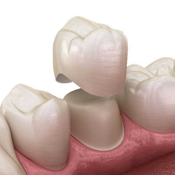 zirconia crown