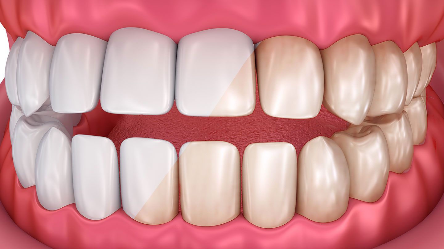 Before and after teeth whitening